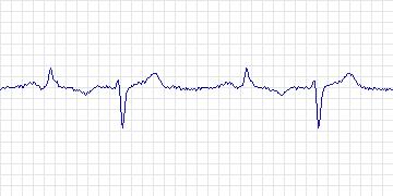 Electrocardiogram for ANSI/AAMI EC13 Test Waveforms, record aami3a