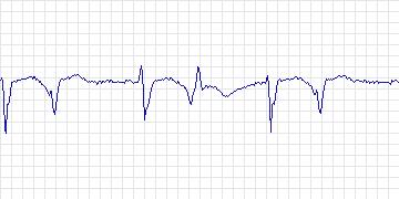Electrocardiogram for ANSI/AAMI EC13 Test Waveforms, record aami3c