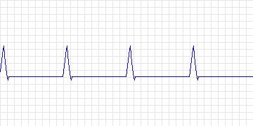 Electrocardiogram for ANSI/AAMI EC13 Test Waveforms, record aami4a_d