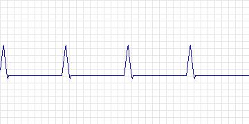 Electrocardiogram for ANSI/AAMI EC13 Test Waveforms, record aami4a_h