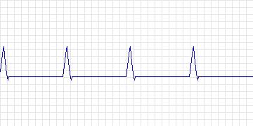 Electrocardiogram for ANSI/AAMI EC13 Test Waveforms, record aami4b_d