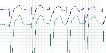Electrocardiogram for MIT-BIH Atrial Fibrillation, record 06426