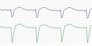 Electrocardiogram for MIT-BIH Atrial Fibrillation, record 06453