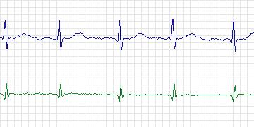 Electrocardiogram for MIT-BIH Atrial Fibrillation, record 06995
