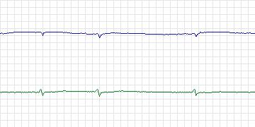 Electrocardiogram for MIT-BIH Atrial Fibrillation, record 07162
