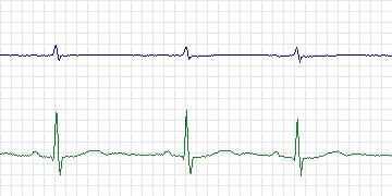 Electrocardiogram for MIT-BIH Atrial Fibrillation, record 07879