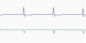 Electrocardiogram for MIT-BIH Atrial Fibrillation, record 07910