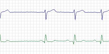 Electrocardiogram for MIT-BIH Atrial Fibrillation, record 08215