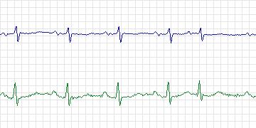 Electrocardiogram for MIT-BIH Atrial Fibrillation, record 08219