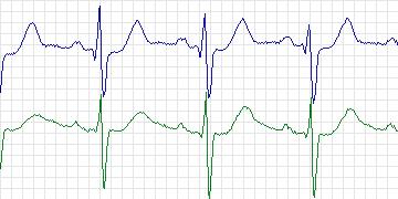 Electrocardiogram for MIT-BIH Atrial Fibrillation, record 08378