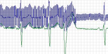 Electrocardiogram for MIT-BIH Atrial Fibrillation, record 08405