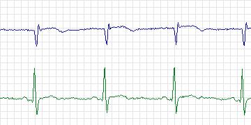 Electrocardiogram for MIT-BIH Atrial Fibrillation, record 08434