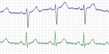 Electrocardiogram for MIT-BIH Atrial Fibrillation, record 08455