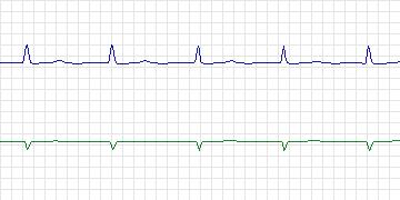 Electrocardiogram for PAF Prediction Challenge, record n01c