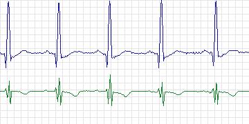 Electrocardiogram for PAF Prediction Challenge, record n25c