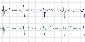 Electrocardiogram for PAF Prediction Challenge, record n41c