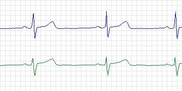 Electrocardiogram for PAF Prediction Challenge, record n42c