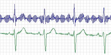 Electrocardiogram for PAF Prediction Challenge, record p01