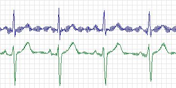 Electrocardiogram for PAF Prediction Challenge, record p01c