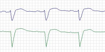 Electrocardiogram for PAF Prediction Challenge, record p23c