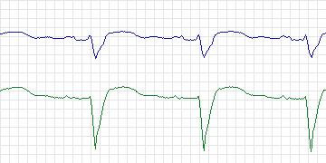 Electrocardiogram for PAF Prediction Challenge, record p24