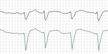 Electrocardiogram for PAF Prediction Challenge, record p24c