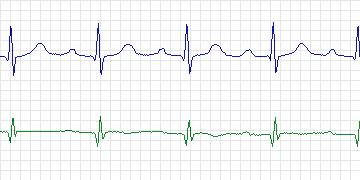 Electrocardiogram for PAF Prediction Challenge, record p25