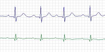 Electrocardiogram for PAF Prediction Challenge, record p25c