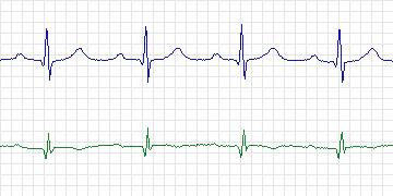 Electrocardiogram for PAF Prediction Challenge, record p26
