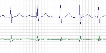 Electrocardiogram for PAF Prediction Challenge, record p26c
