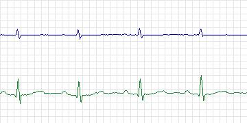 Electrocardiogram for PAF Prediction Challenge, record p27