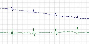 Electrocardiogram for PAF Prediction Challenge, record p27c