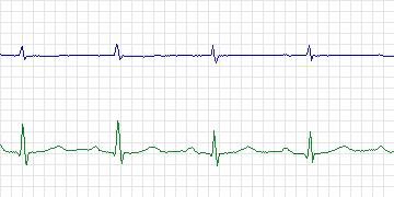 Electrocardiogram for PAF Prediction Challenge, record p28
