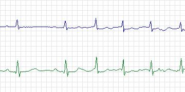 Electrocardiogram for PAF Prediction Challenge, record p28c