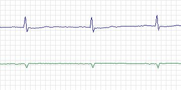 Electrocardiogram for PAF Prediction Challenge, record p29