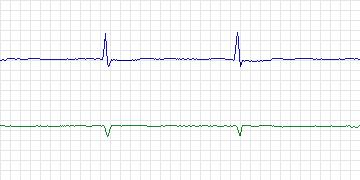 Electrocardiogram for PAF Prediction Challenge, record p29c