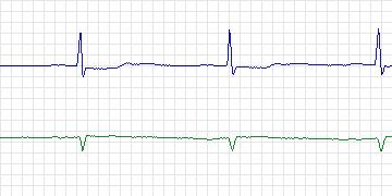 Electrocardiogram for PAF Prediction Challenge, record p30