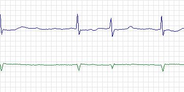 Electrocardiogram for PAF Prediction Challenge, record p30c