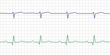 Electrocardiogram for PAF Prediction Challenge, record p31