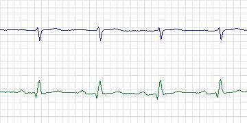 Electrocardiogram for PAF Prediction Challenge, record p31c