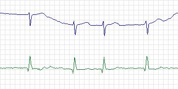 Electrocardiogram for PAF Prediction Challenge, record p32c