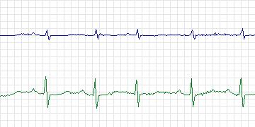 Electrocardiogram for PAF Prediction Challenge, record p33