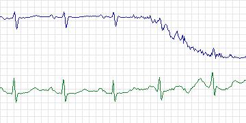 Electrocardiogram for PAF Prediction Challenge, record p33c