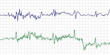 Electrocardiogram for PAF Prediction Challenge, record p34