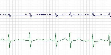 Electrocardiogram for PAF Prediction Challenge, record p34c