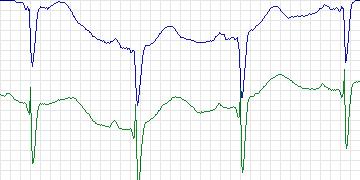 Electrocardiogram for PAF Prediction Challenge, record p35c