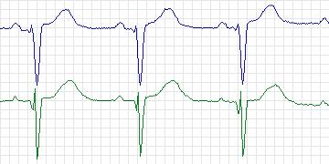 Electrocardiogram for PAF Prediction Challenge, record p36