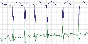 Electrocardiogram for PAF Prediction Challenge, record p48c