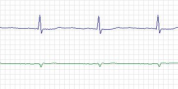 Electrocardiogram for PAF Prediction Challenge, record p49