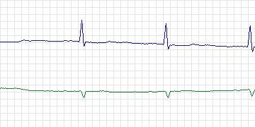 Electrocardiogram for PAF Prediction Challenge, record p49c